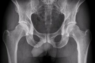 Ways to diagnose osteoarthritis of the hip joint