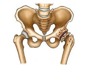 What is osteoarthritis of the hip joint