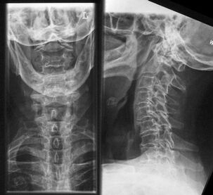 X-ray of the cervical spine - a method of diagnosing osteochondrosis
