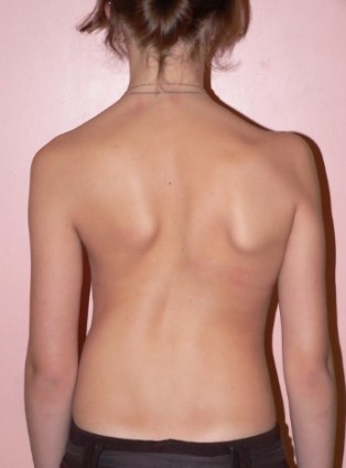 Scoliosis Of 2 Degrees
