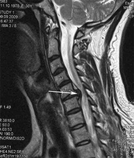 Damage to the spinal cord causes neck pain