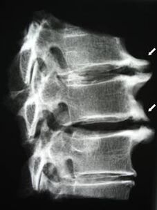 Osteophytes in the cervical spine cause neck pain