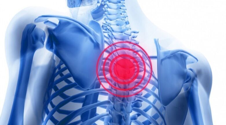 Back pain can be associated with a herniated disc