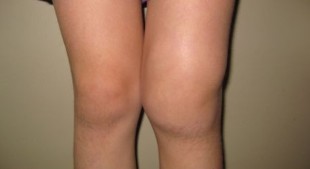 Deformity of the knee