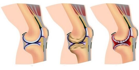 a healthy joint and pain in the destruction of the knee joint