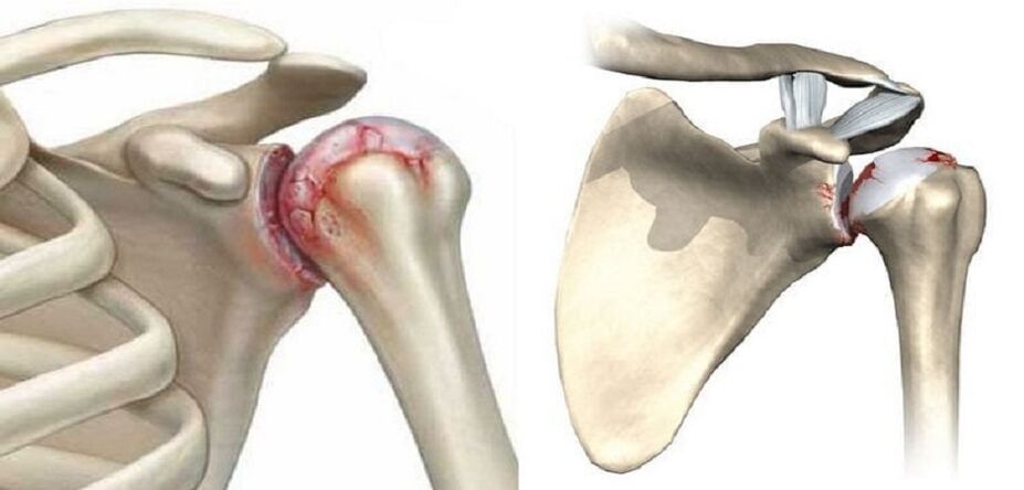Destruction of the shoulder joint in osteoarthritis