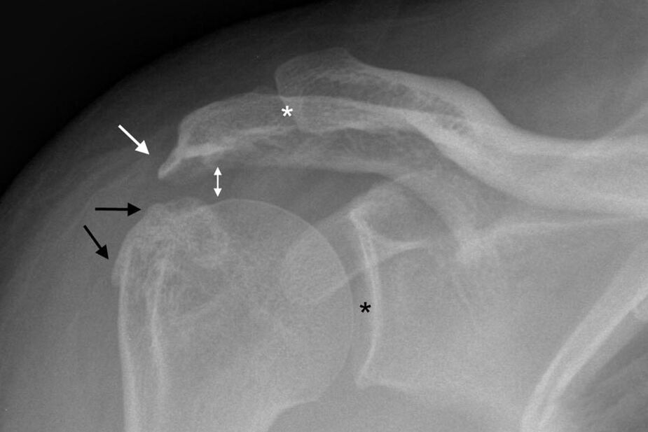 X-ray osteoarthritis of the shoulder joint