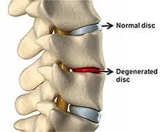 the normal disc of the spine, the damaged Disc